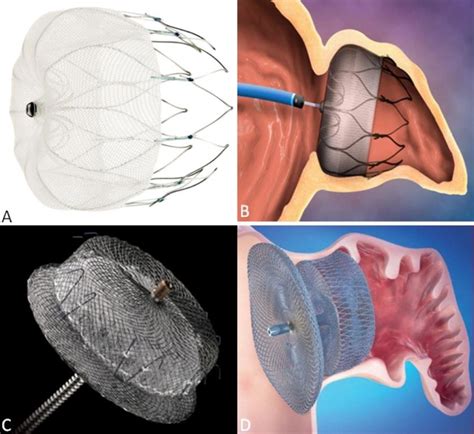 Left Atrial Appendage Closure Device