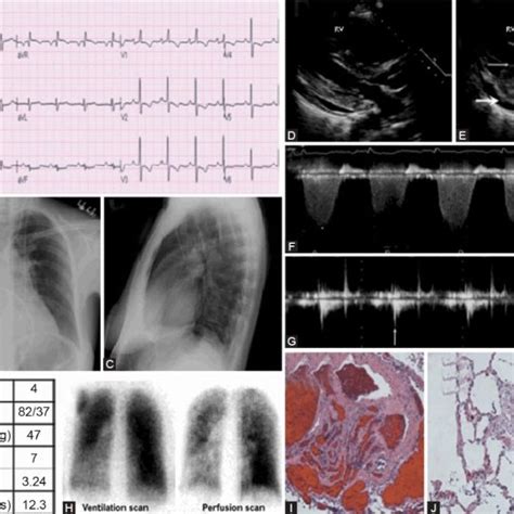 WHO Group 5 – Pulmonary hypertension with unclear or multifactorial... | Download Scientific Diagram