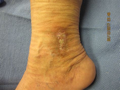 Venous Ulcer Wound Healing