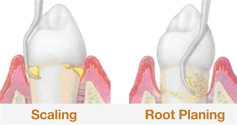 NOVA Dental | Post-Operative Care for your teeth after Scaling and Root Planing