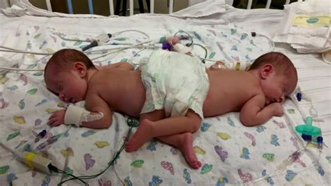 Conjoined sisters undergo rare separation surgery - CNN Video