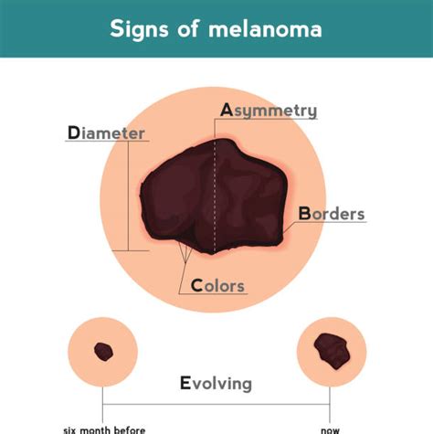 List 98+ Pictures Anatomy Of A Mole On The Skin Updated