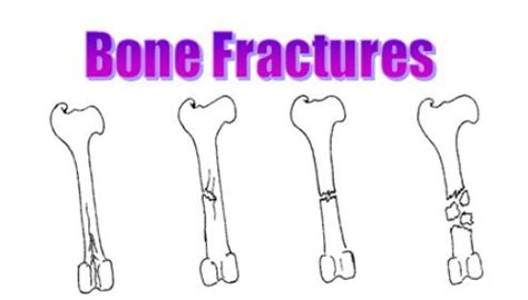 Bone Fractures Diagram | Quizlet