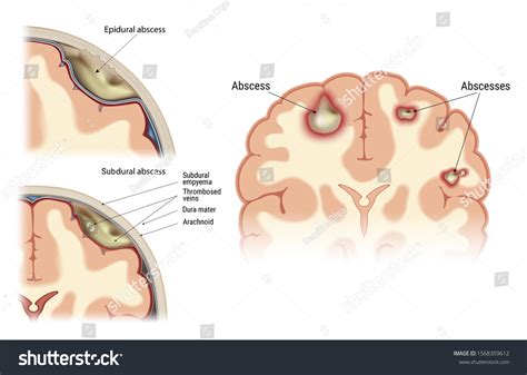 Abscess Human Brain Visual Image Location Stock Vector (Royalty Free ...