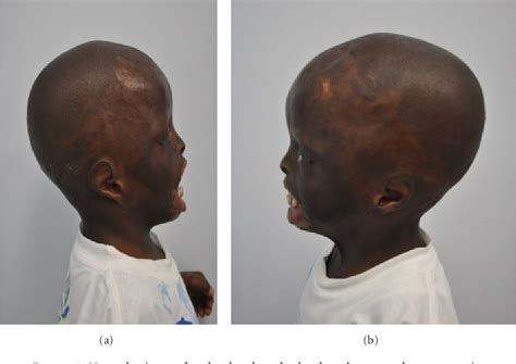 Figure 2 from Clinical Variant of Ablepharon Macrostomia Syndrome ...