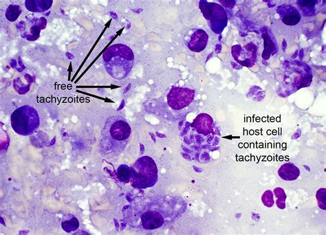 Toxoplasma Gondii Brain Abscess