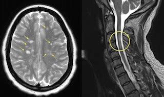 Ms Lesions Pictures - the meta pictures