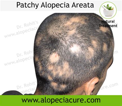 Alopecia areata - Treatment, Types, Causes