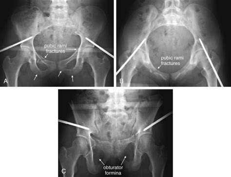 [Download 39+] Pelvis Image Xray