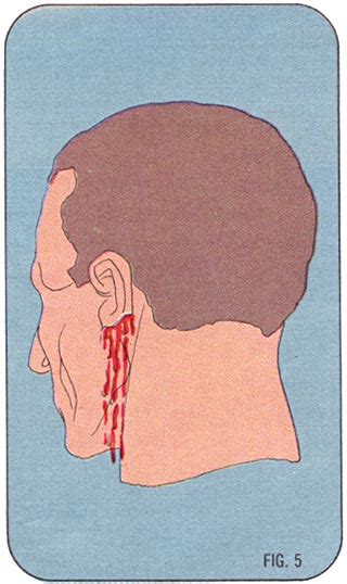 DIAGRAM >> Avulsions (Fig. 5)