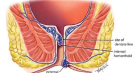 Hemorrhoid Banding | GI Associates