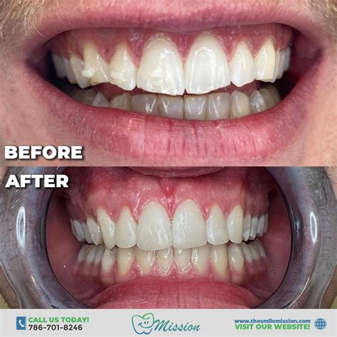 Composite Veneers - Dentist in Miami, FL | The Smile Mission