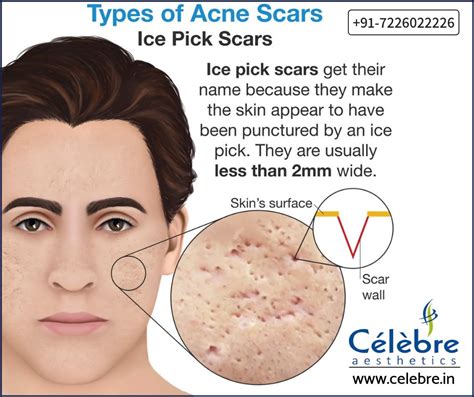 Ice Pick Acne Scar