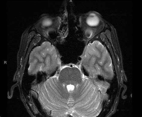 Microvascular Decompression and Radiofrequency Lesioning for Trigeminal Neuralgia - cns.org