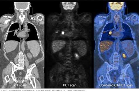 PET - CT Scans: Aegle Cancer Hospital Mauritius