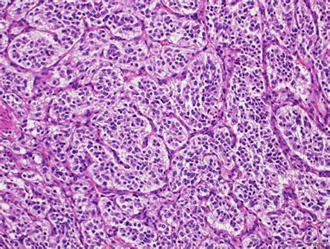 Hematoxylin and eosin staining of the resected specimen | Download Scientific Diagram