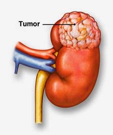 Brady Urology at Johns Hopkins Hospital: Oncocytoma: A Benign Kidney ...