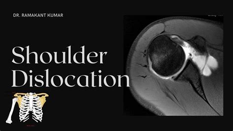 Shoulder Dislocation Treatment - Dislocated Shoulder Recovery