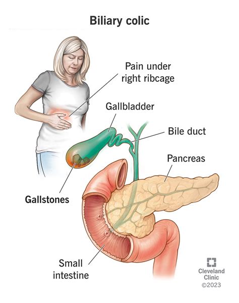 Biliary Colic: What It Is, Symptoms & Treatment