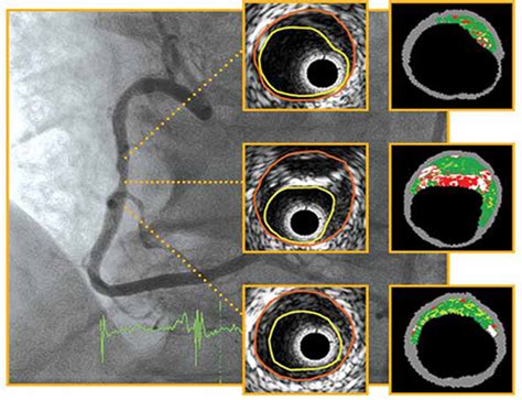 Intracoronary Imaging - IVUS and OCT - Lim Ing Haan Cardiology Clinic