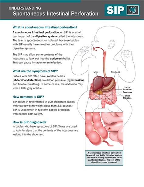 Spontaneous Intestinal Perforation (SIP) - NICU Parent Education Resources