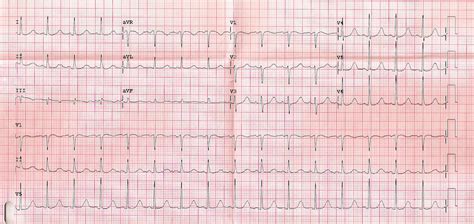 Hypocalcemia – Core EM