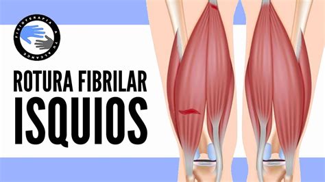 Rotura fibrilar de los isquiotibiales, que es, por que se produce, diagnostico y tratamiento ...