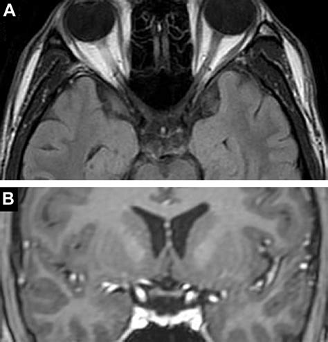 Magnetic resonance imaging of optic nerve and chiasm. (A) Axial FLAIR ...