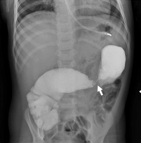 Lower GI contrast study. White arrow: Distal transverse colonic stricture. | Download Scientific ...