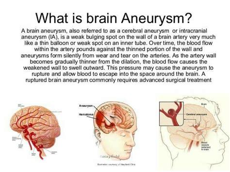 What is an aneurysm ? | Brain aneurysm, Aneurysm, Brain aneurysm survivor