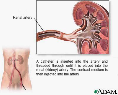 Renal artery angiography / angioplasty