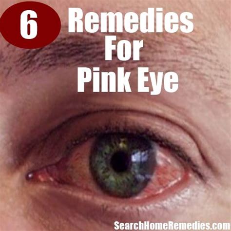 Pin by Charleen Glass on Home Remedies | Pinkeye remedies, Pink eye home remedies, Home remedies