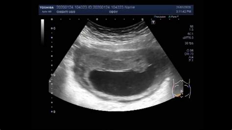 Ultrasound Video showing A missed abortion with intrauterine fetal demise. - YouTube