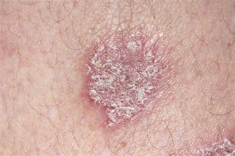 Chronic plaque psoriasis - Stock Image - M240/0768 - Science Photo Library