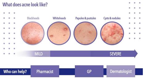 Mild to Moderate Acne – What Does It Look Like & How To Treat It?