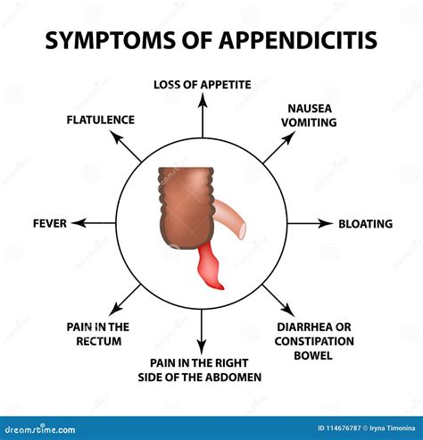 Objawy Appendicitis Rozognienie Apendyks Infographics Wektorowa ...