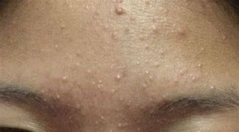 Causes and How to Get Rid of Whiteheads on Forehead - Skincarederm