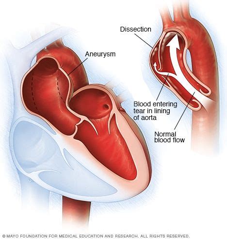 Aortic dissection - Symptoms and causes - Mayo Clinic | Aortic ...