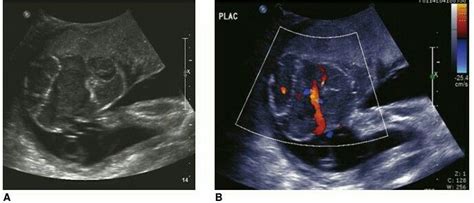 Chorioangioma. A: Large ovoid mass protruding from fetal surface of the ...