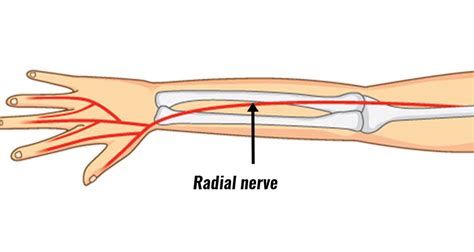 Radial Tunnel Syndrome - Symptoms, Causes, Treatment & Exercises
