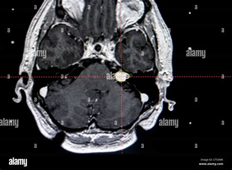 ACOUSTIC NEUROMA, MRI Stock Photo, Royalty Free Image: 49285311 - Alamy