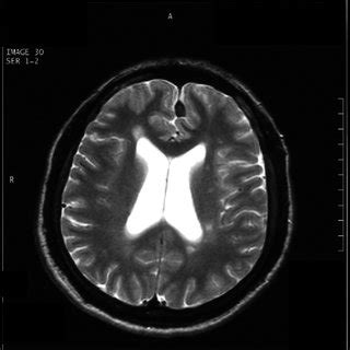 MRI of patient B showing periventricular and subcortical white matter... | Download Scientific ...