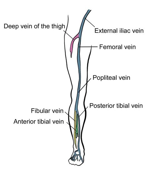 Deep Vein Thrombosis in the ED – RCEMLearning India