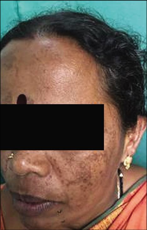 Diffuse facial melanosis – An overview of etiology and dermoscopic findings - Journal of Skin ...