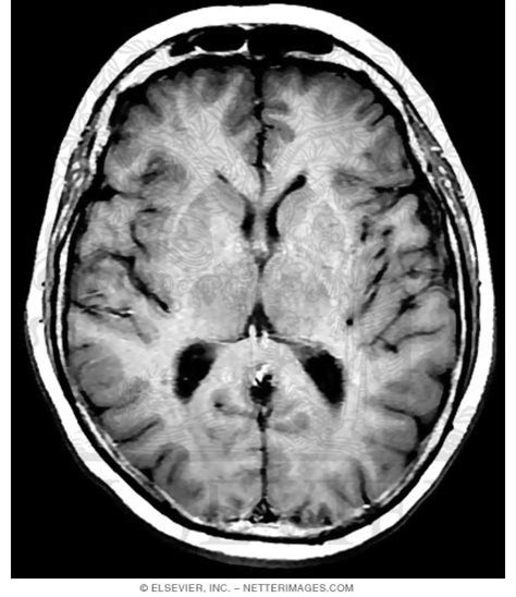 T1-Weighted MRI Before Contrast