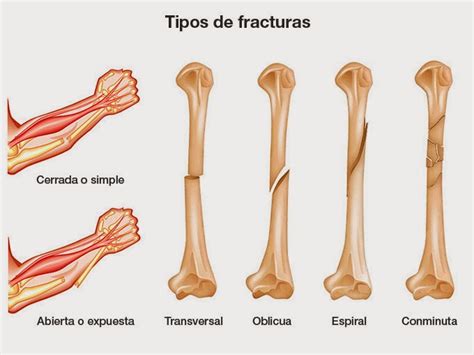 Ayúdate! -: Consejos para recuperarse de una fractura de hueso