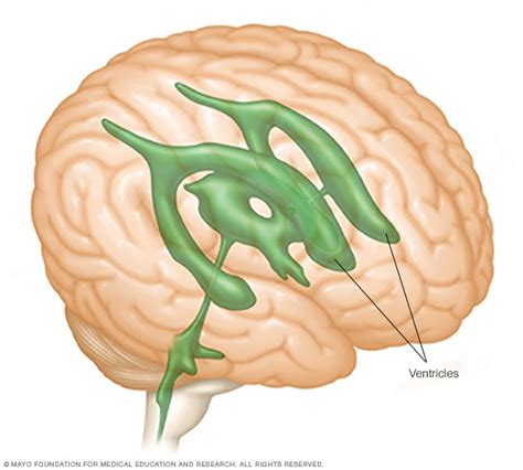 Brain ventricles - Mayo Clinic