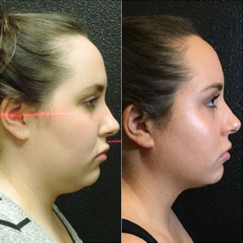 Kybella at Mystique Medical Spa in Fresno, California (559) 447-5273 ...