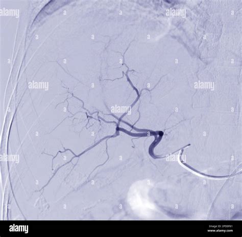 Imaging of TACE or Chemoembolization is a procedure that allows a dose of chemotherapy drugs to ...