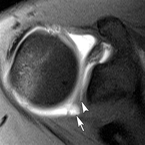 Mri Shoulder Labrum Tear